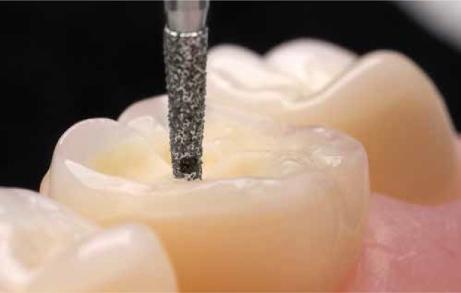 Bộ Mũi Mài Onlay Mặt Nhai Cao Cấp 4665 | Komet Đức