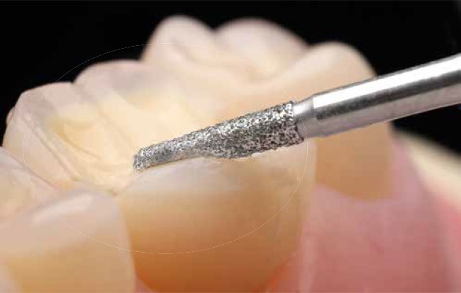 Bộ Mũi Mài Onlay Mặt Nhai Cao Cấp 4665 | Komet Đức