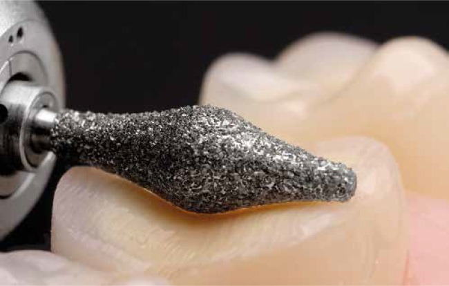 Bộ Mũi Mài Onlay Mặt Nhai Cao Cấp 4665 | Komet Đức