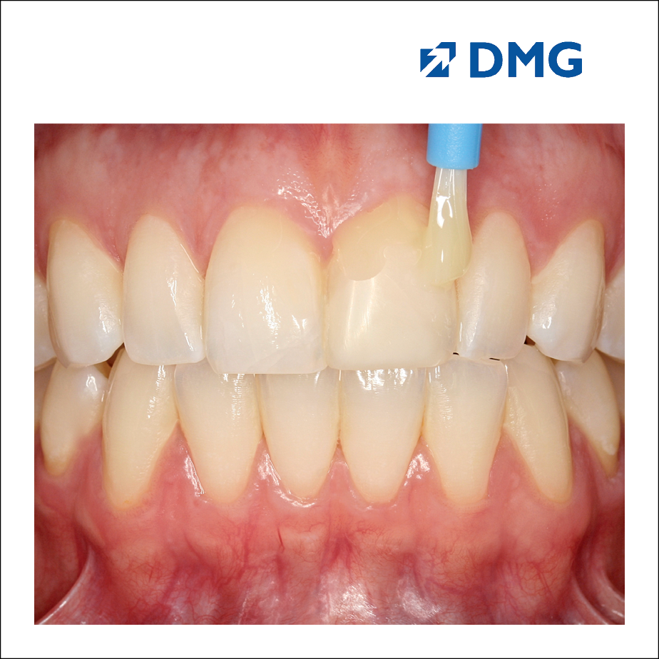 Dự phòng sâu răng Vecni Flairesse