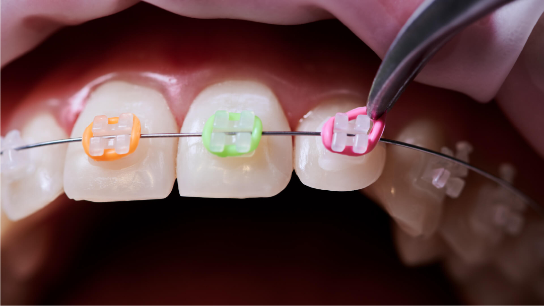 Cẩm Nang Dây Thun Niềng Răng: Tối Ưu Kinh Tế Cho Phòng Khám