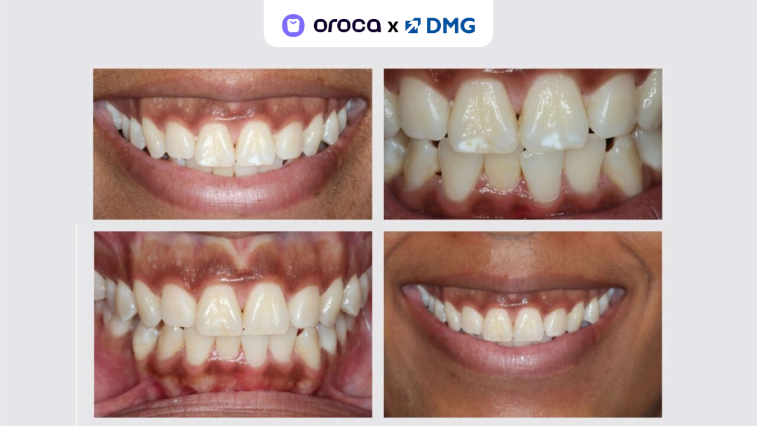 Case Study: Điều trị đốm trắng bằng Icon Vestibular Etch - DMG