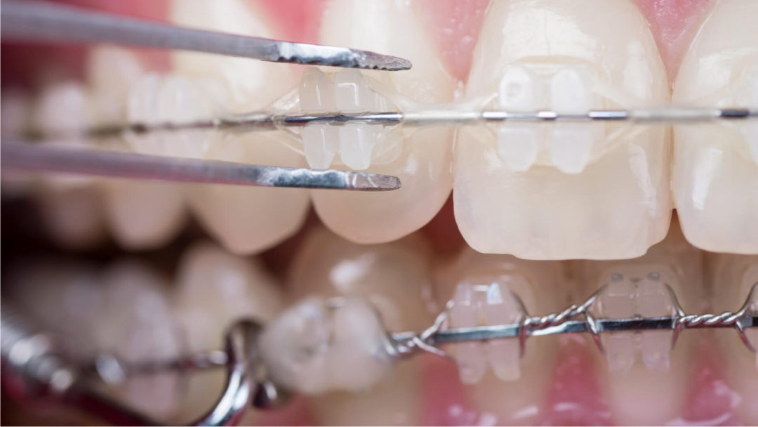 Dây Cung Chỉnh Nha: Phân Loại, Tác Dụng Từng Loại
