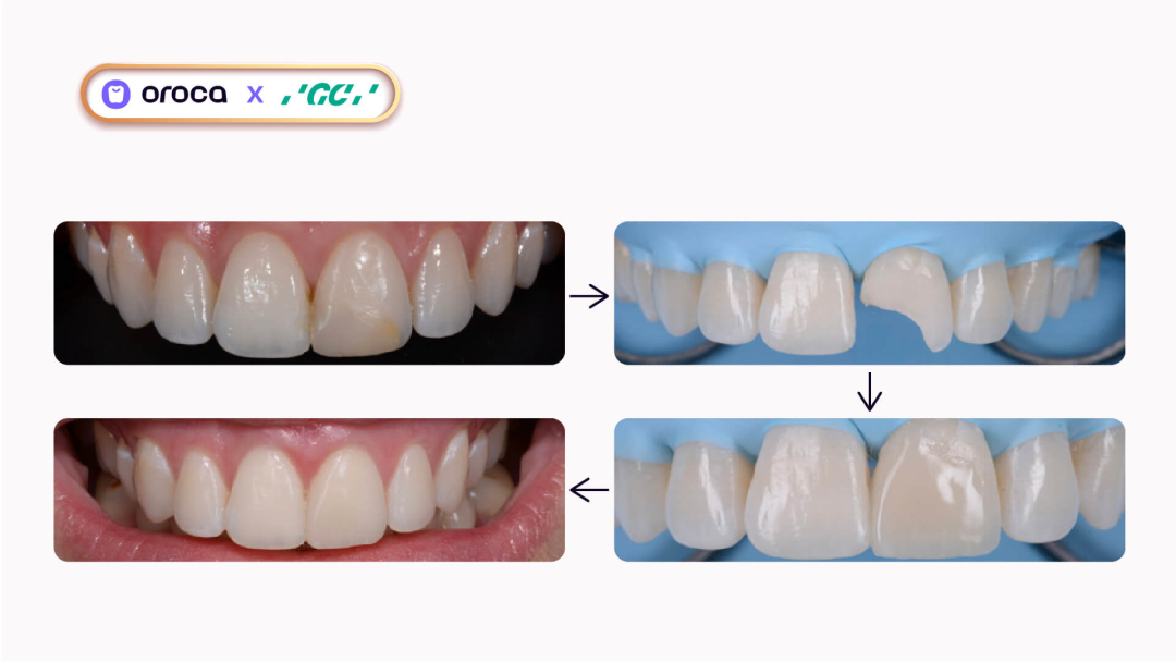 BÁO CÁO LÂM SÀNG: Phục hồi răng cửa mẻ/cũ bằng kỹ thuật phân lớp 3 màu composite